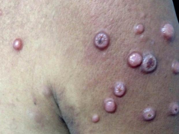 Image of primary cutaneous follicle centre lymphomas on somebody's shoulder