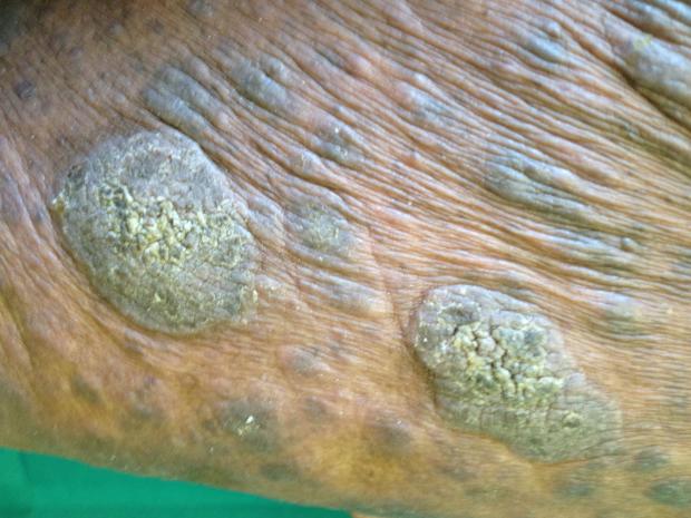 Image of mycosis fungoides tumours