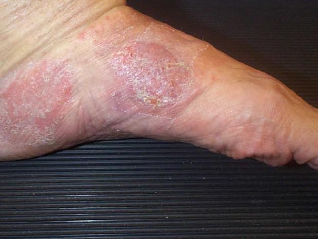 Image of a patch of pagetoid reticulosis on somebody's foot
