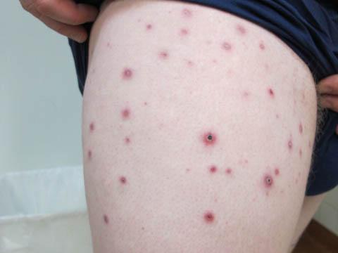 Image of lymphomatoid papulosis (LyP) papules on someone's thigh