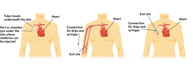 Three illustrations showing the different types of central line. These are a portacath, a peripherally inserted central catheter and a tunnelled central line