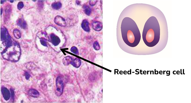 An image of a Reed-Sternberg cell under a microscope