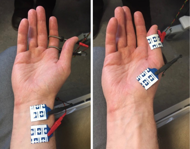 Image of nerve conduction test (NCT) and electromyography (EMG)