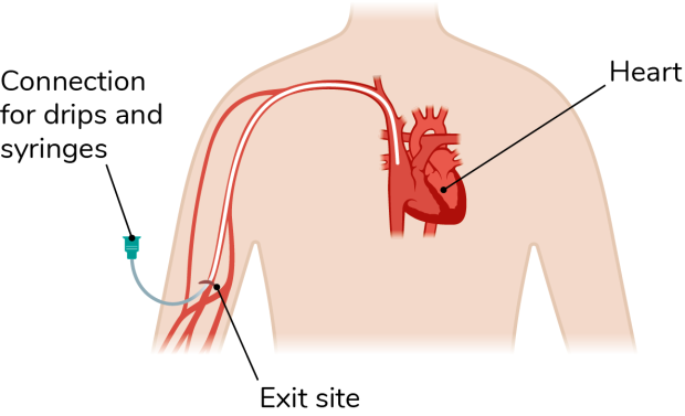 A diagram of somebody's chest illustrating how the PICC line is inserted for drips and syringes