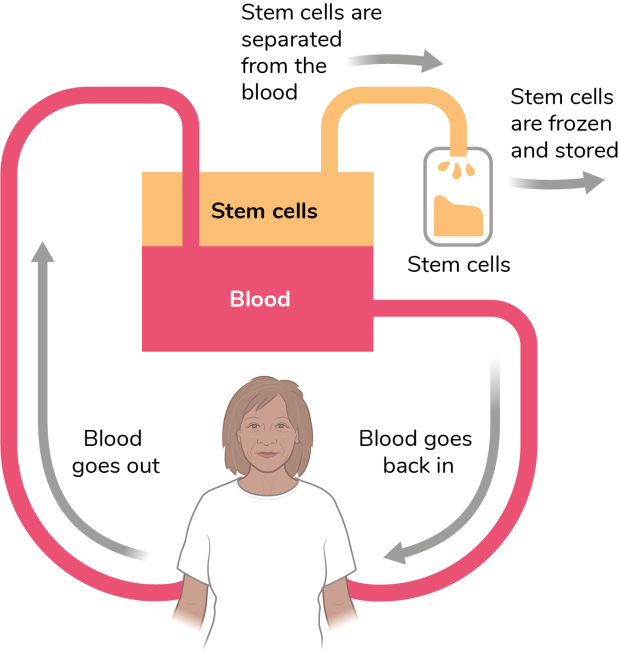 An illustrated diagram of an older woman going through stem cell collection where the blood is taken out, the stem cells are separated from the blood, the stem cells are then frozen and stored, and finally the blood goes back in
