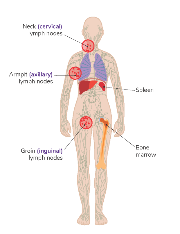 An illustrated diagram of a body displaying where CLL/SLL is most often found: neck (cervical) lymph nodes, armpit (axillary) lymph nodes, groin (inguinal) lymph nodes, spleen and bone marrow l