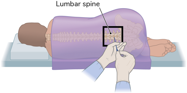 An illustated diagram of somebody receiving a lumbar puncture, which goes into their lumbar spine which is lower.