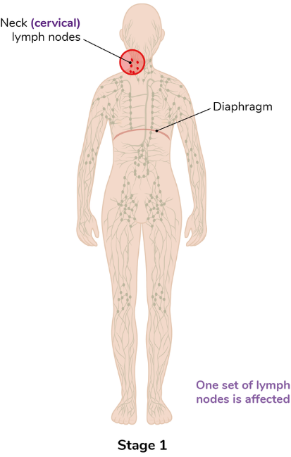 A diagram of stage 1 lymphoma where it is illustrated to be in the neck of somebody with the test 'Neck (cervical lymph nodes)' as well as a line demonstrating where the diaphragm is