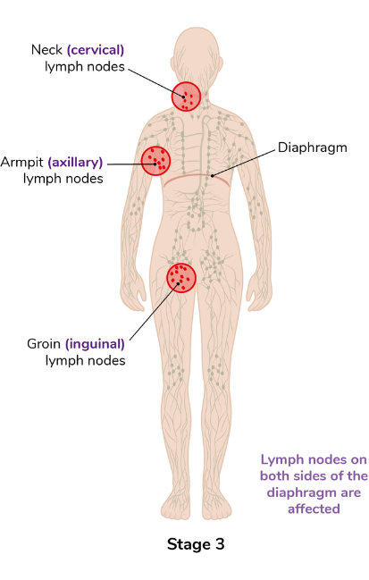 A diagram of stage 3 lymphoma where lymph nodes on both sides of the diaphragm are affected. The neck (cervical) lymph nodes, armpit (axillary) lymph nodes, groin (inguinal) lymph nodes and diaphragm are highlighted