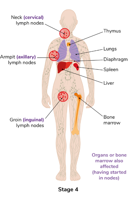 A diagram of stage 4 lymphoma. Organs or bone marrow are also affected (having started in nodes). The neck (cervical) lymph nodes, armpit (axillary) lymph nodes, groin (inguinal) lymph nodes, thymus, lungs, diaphragm, spleen, liver and bone marrow are all highlighted