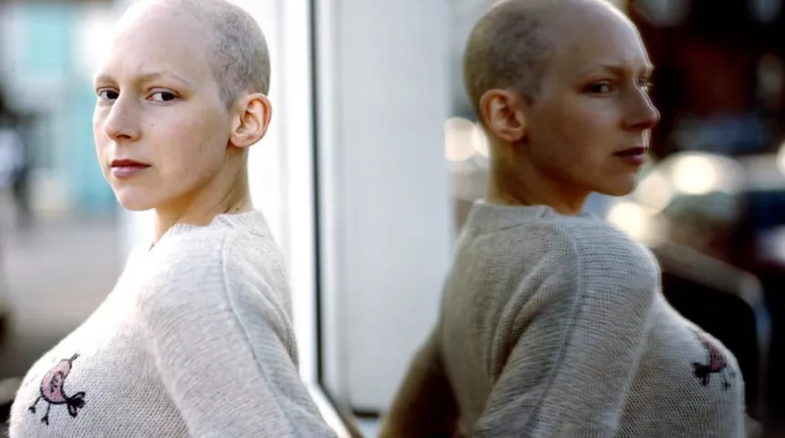 Young woman with hair loss